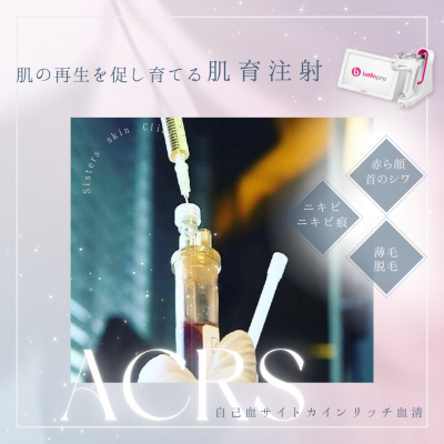 ＡＣＲＳ導入